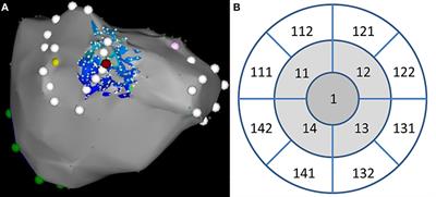 Early and Delayed Alteration of Atrial Electrograms Around Single Radiofrequency Ablation Lesion